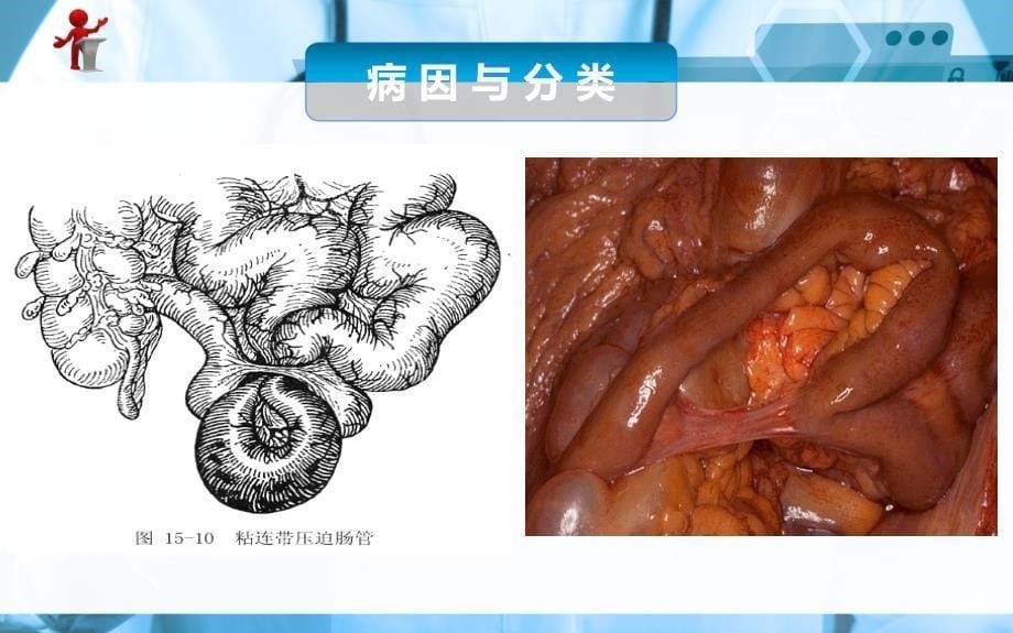 《外科护理》第十五章 第五节肠梗阻病人的护理﹎_第5页