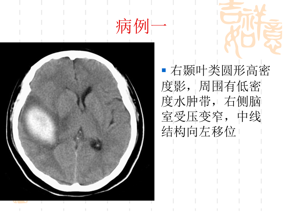 医学影像学病例讲解(MRI、CT、DR)-_第2页