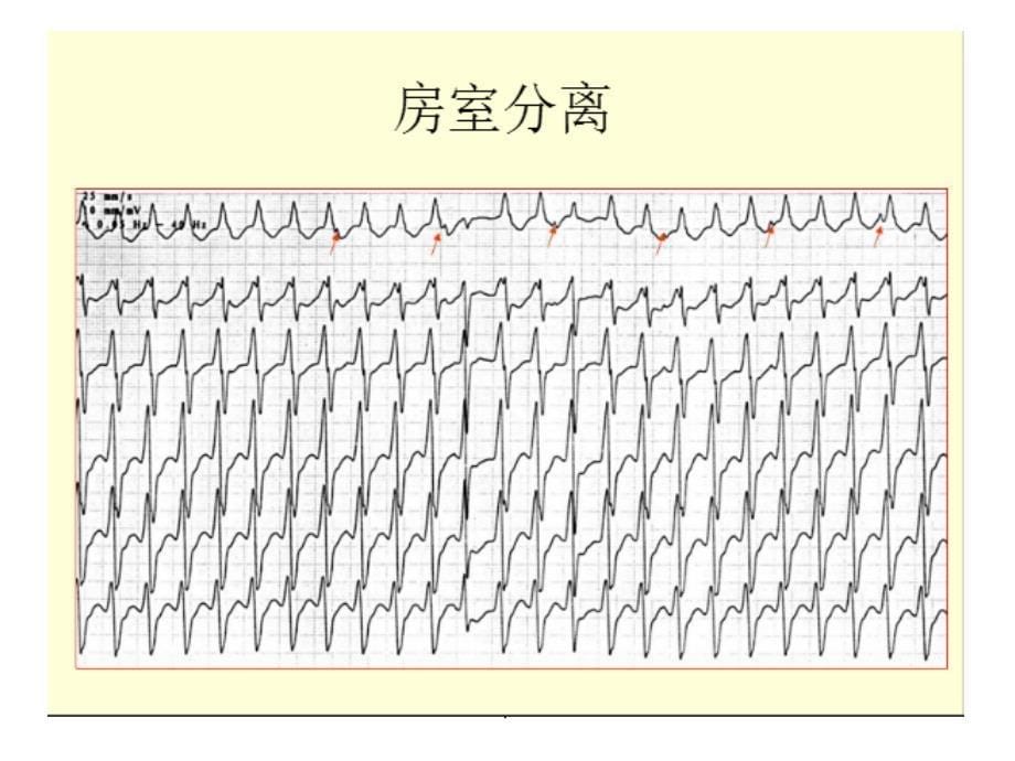 宽QRS波的鉴别诊断_第5页