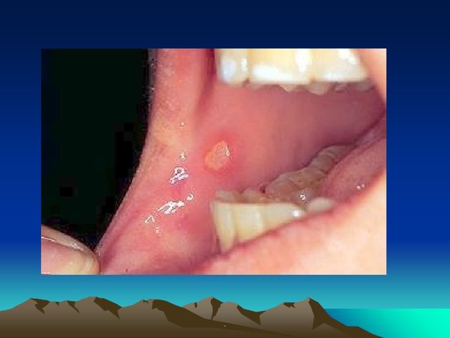 口腔黏膜病学第四章 溃疡_第5页