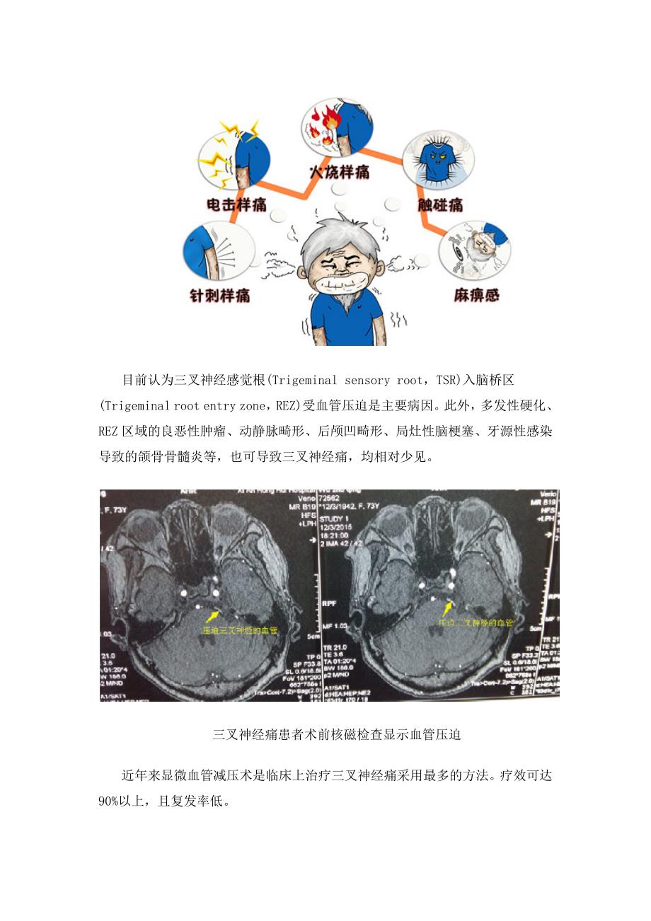 (图解)微血管减压手术治疗三叉神经痛的过程-_第2页