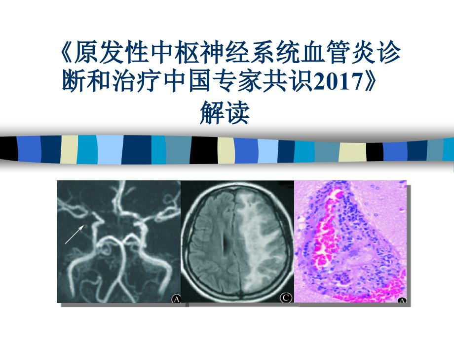 精编《原发性中枢神经系统血管炎诊断和治疗中国专家共识2017》解读-_第1页