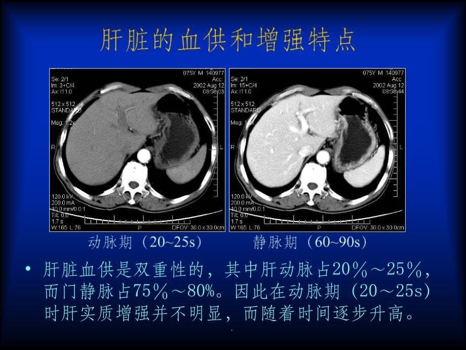 原发性肝癌CT诊断ppt课件_第5页