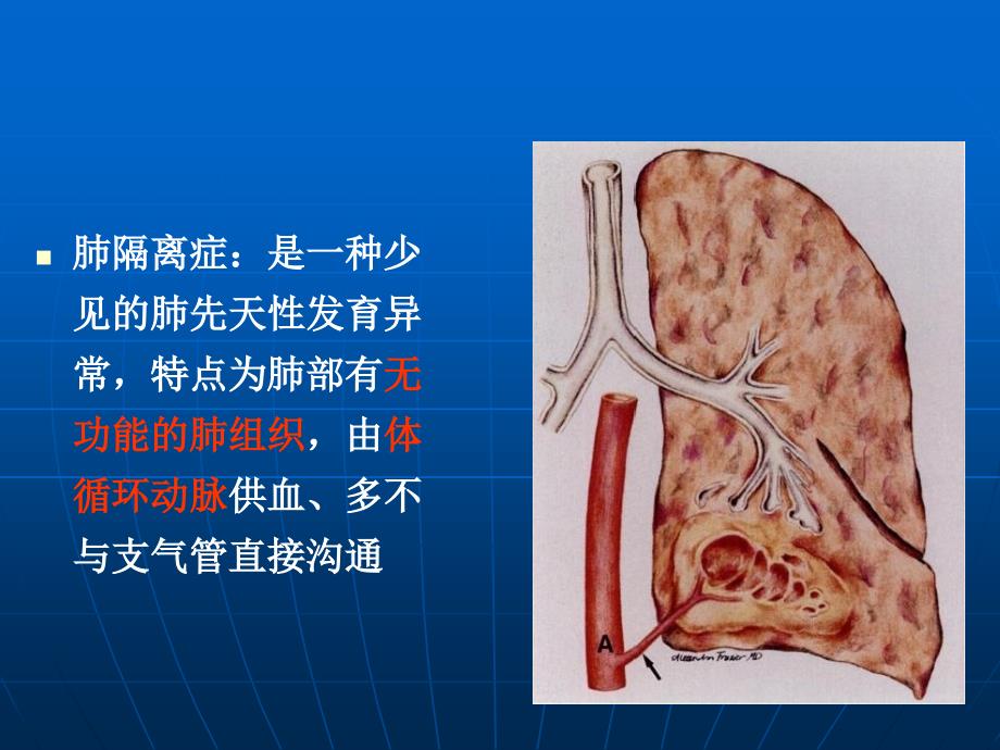 肺隔离症的影像表现幻灯片_第2页