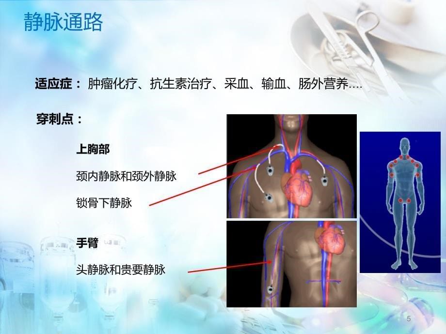 输液港术后维护及并发症处理PPT参考课件_第5页