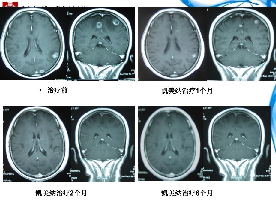 凯美纳治疗肺癌脑转移病例分享精品课件_第4页