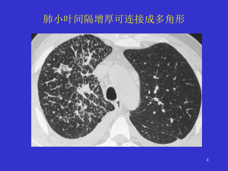 间质性肺疾病的CT诊断幻灯片_第4页