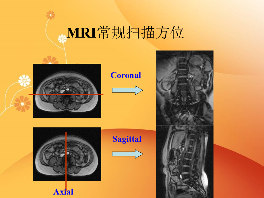 脊柱常见疾病的MRI诊断幻灯片_第3页