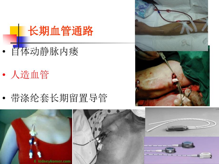 （优质医学）血管通路系列3-人造血管内瘘_第2页