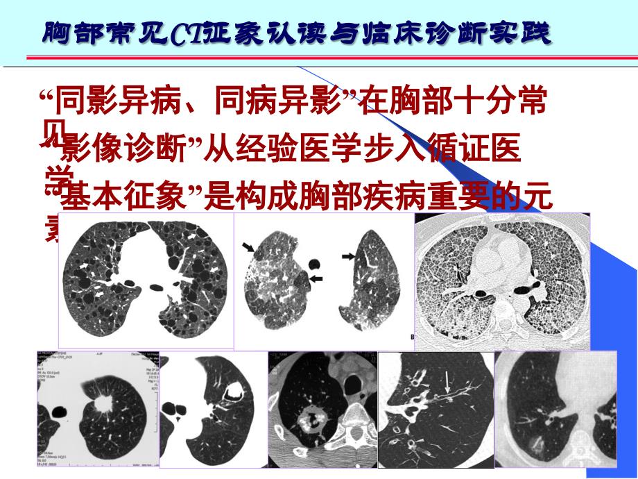 肺部CT十大征象诊断应用幻灯片_第2页