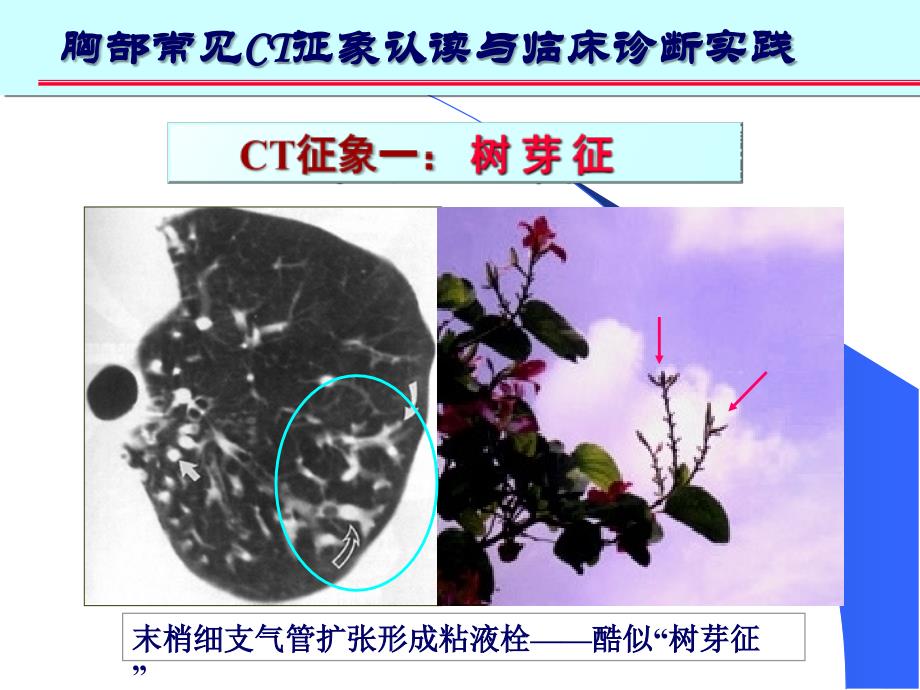肺部CT十大征象诊断应用幻灯片_第4页