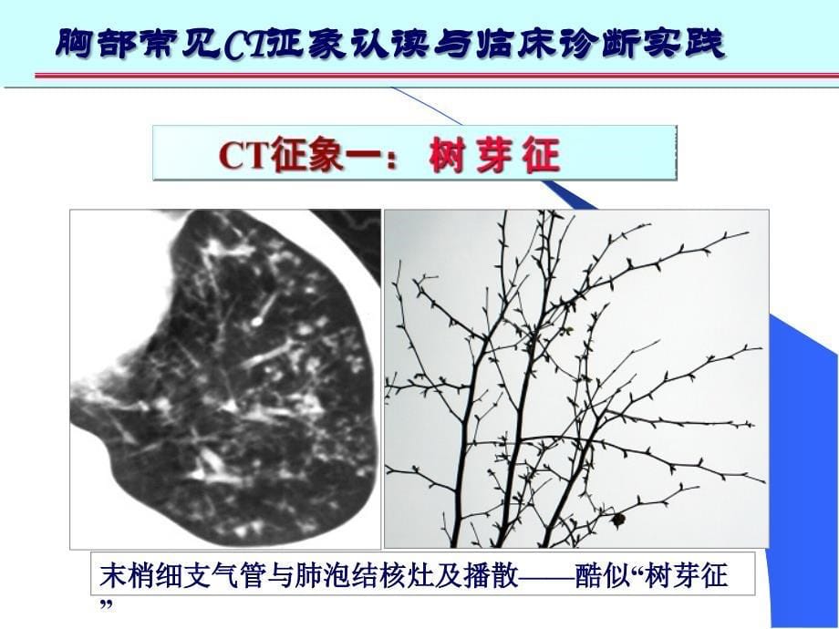 肺部CT十大征象诊断应用幻灯片_第5页