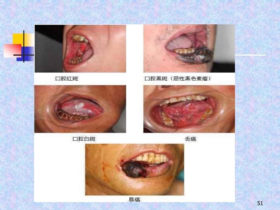 （优质医学）口腔癌及其预防_第5页