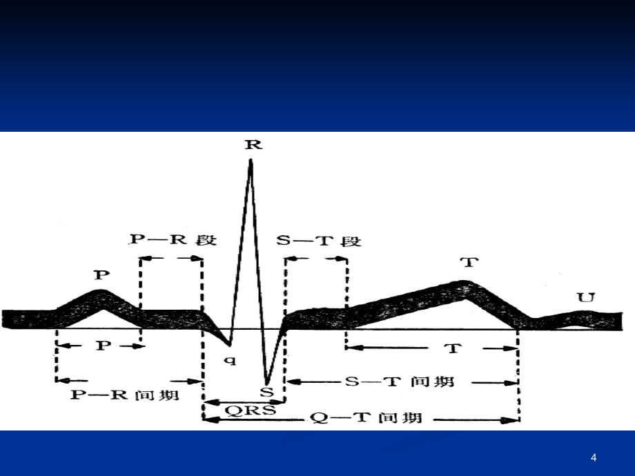 经典：常见心电图诊断与临床幻灯片_第4页