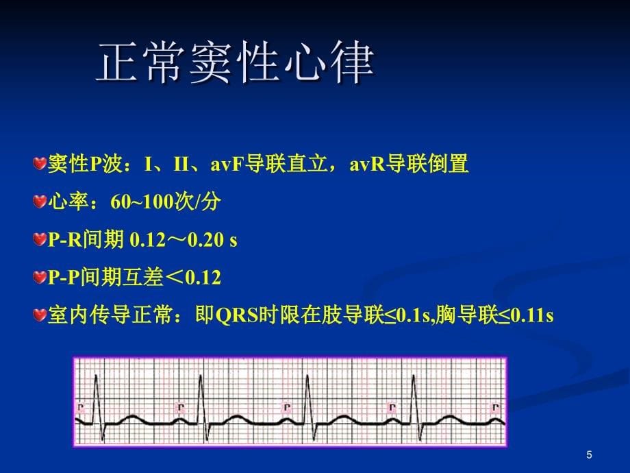 经典：常见心电图诊断与临床幻灯片_第5页