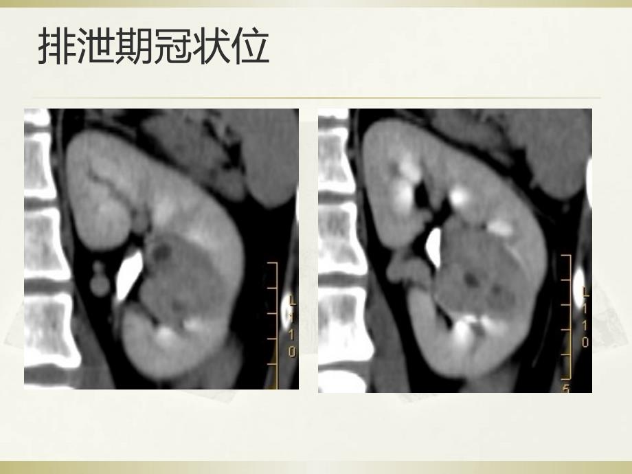 教学读片肾脏富血供肿瘤CT诊断精品课件_第4页