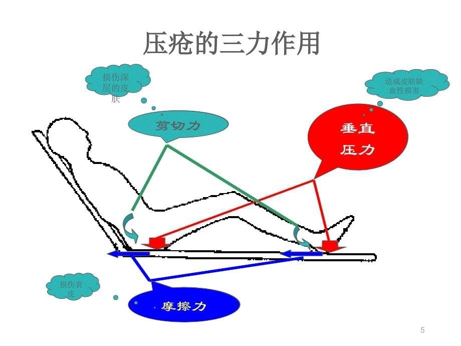 最新压疮相关知识演示课件_第5页