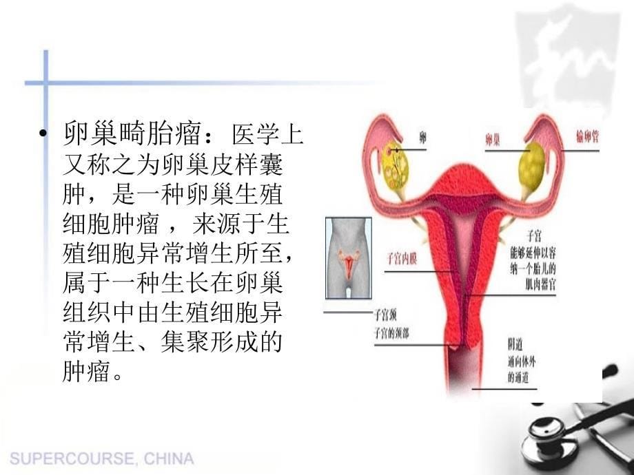 卵巢畸胎瘤精品课件_第5页