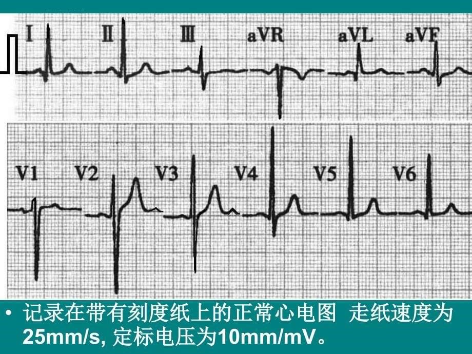 心电图技能培训课件_第5页