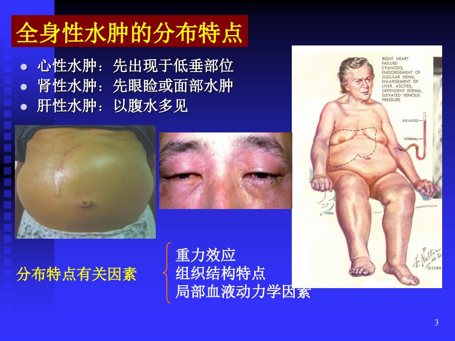 （优质医学）水肿_第3页