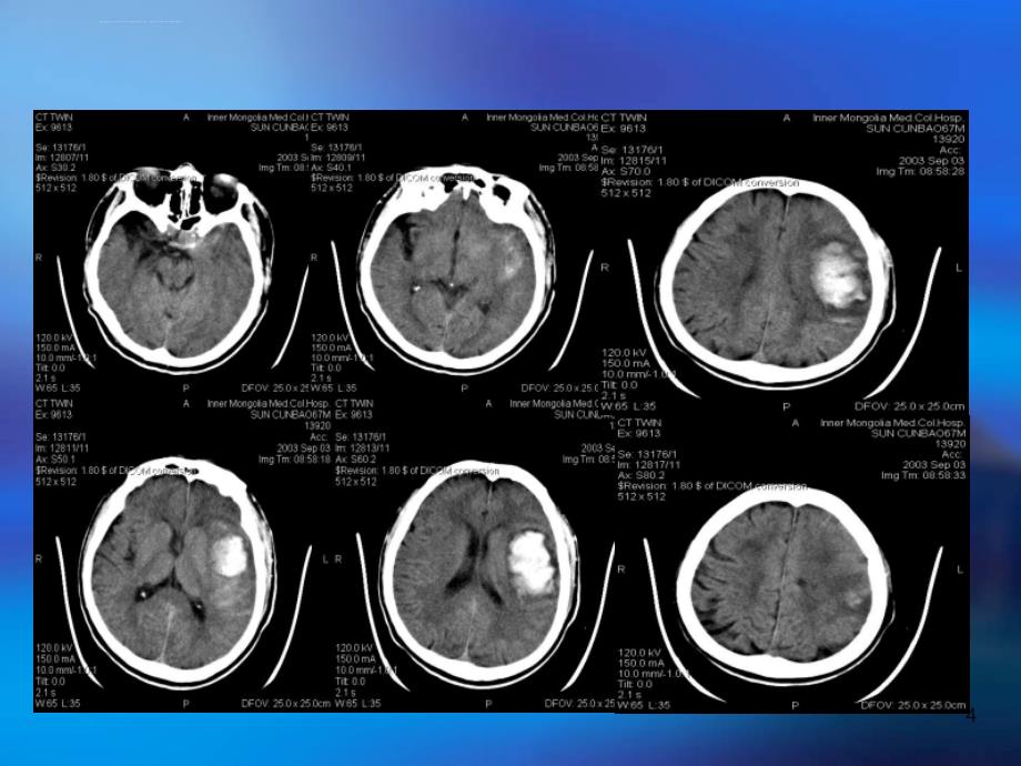 微创颅内血肿清除术治疗高血压脑出血例分析课件_第4页
