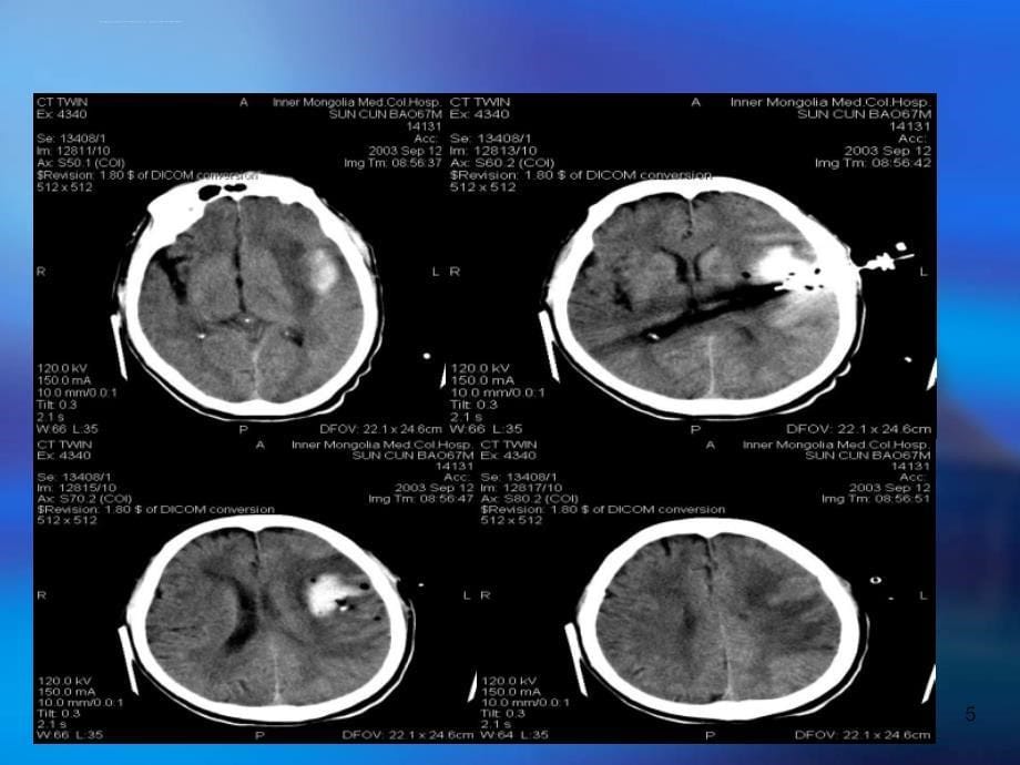 微创颅内血肿清除术治疗高血压脑出血例分析课件_第5页
