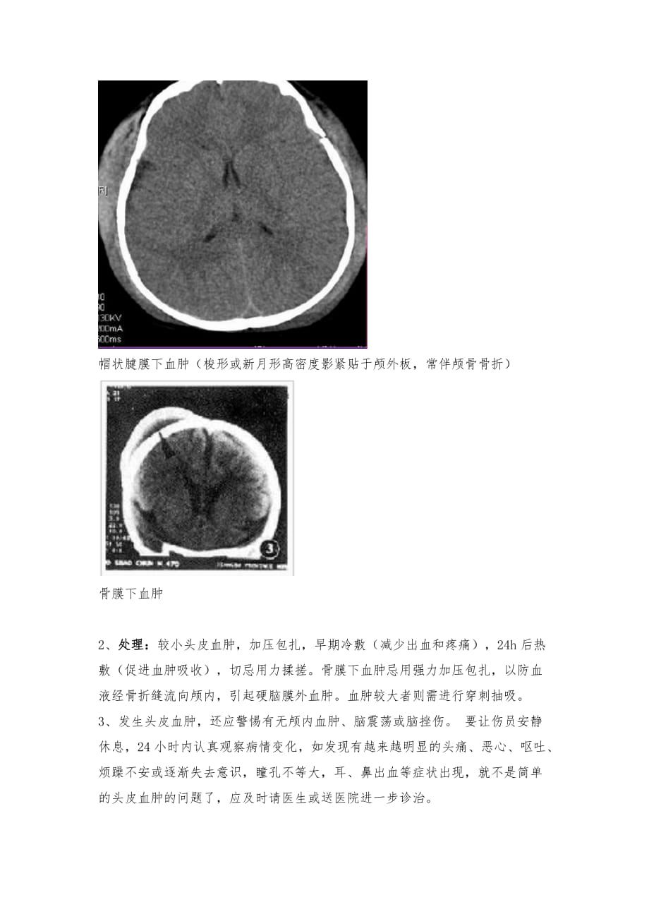 血肿类型及比较_第2页