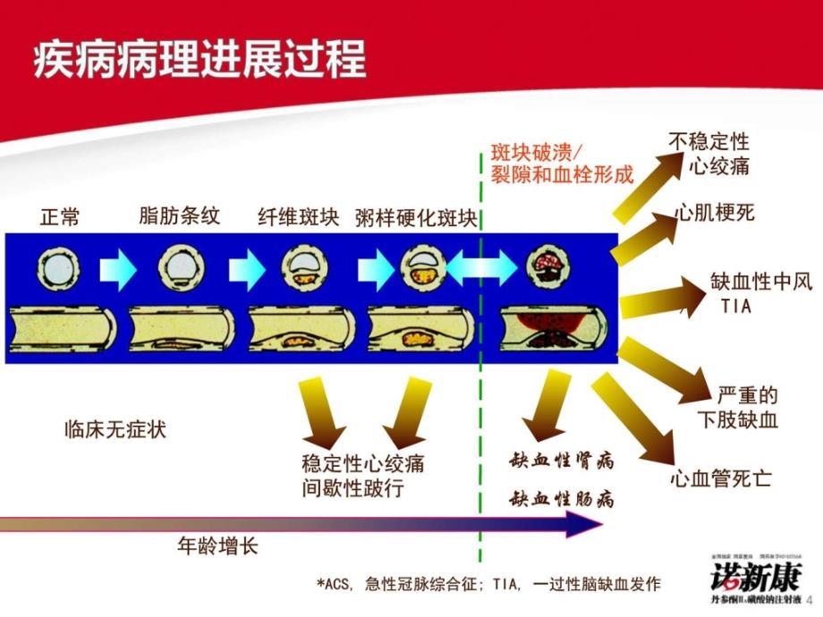 心血管疾病之冠心病课件_第4页