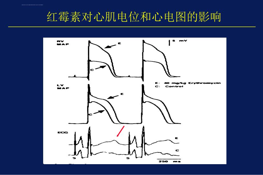 尖端扭转性室速课件_第4页