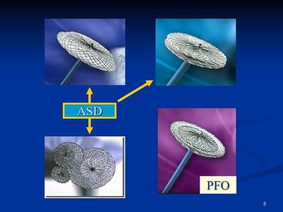 心脏病的介入治疗PPT演示课件_第5页