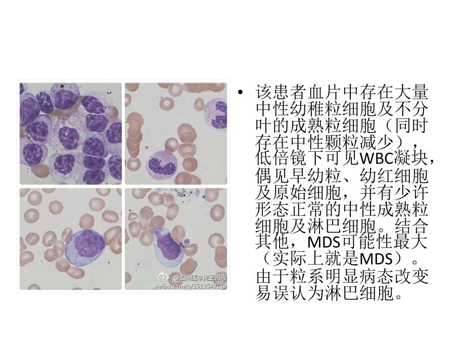 血涂片病例集合课件_第4页