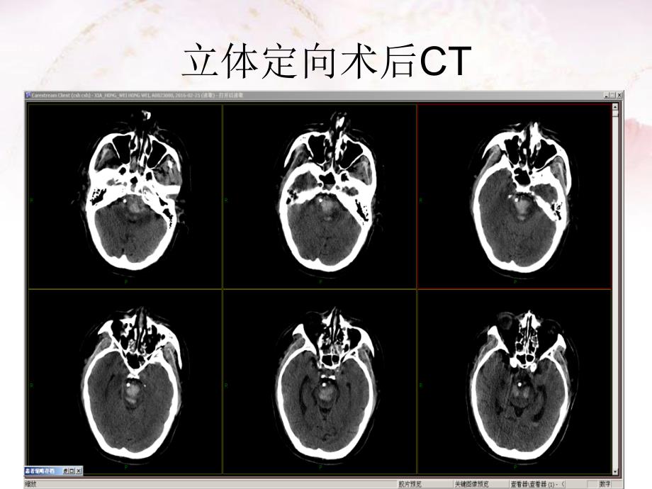 脑干出血治疗体会课件_第4页