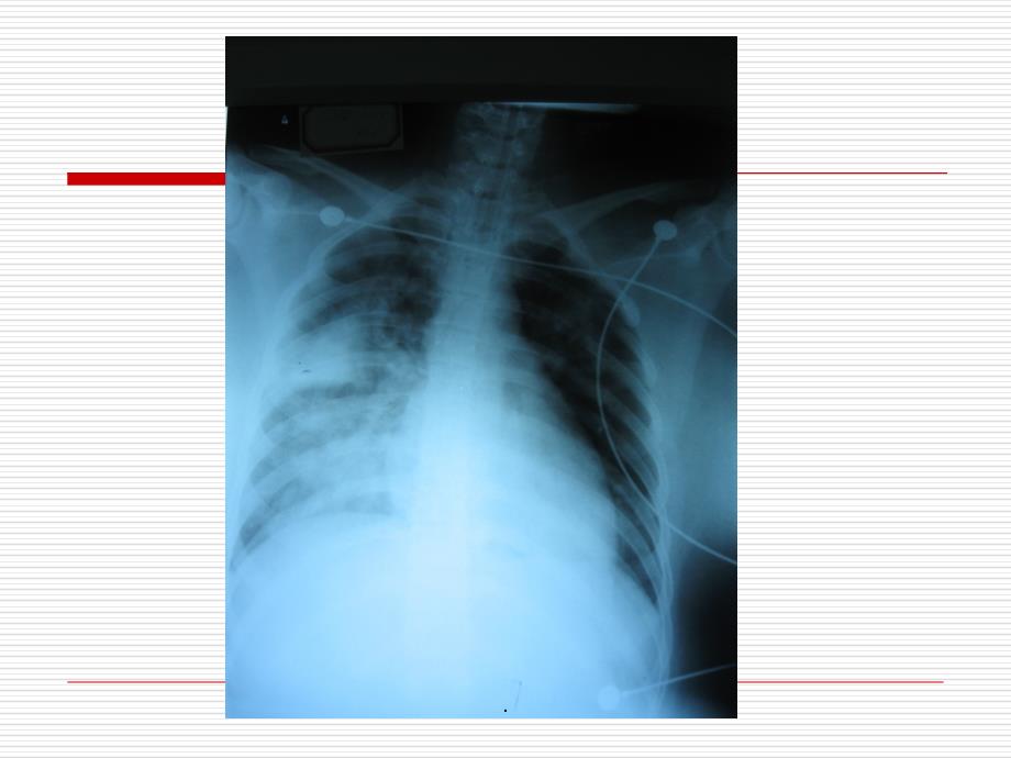 体外膜肺氧合(ECMO)与护理ppt课件_第4页
