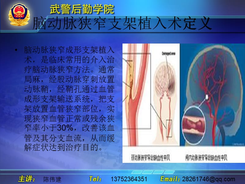 1174编号脑动脉狭窄支架植入术及护理_第3页