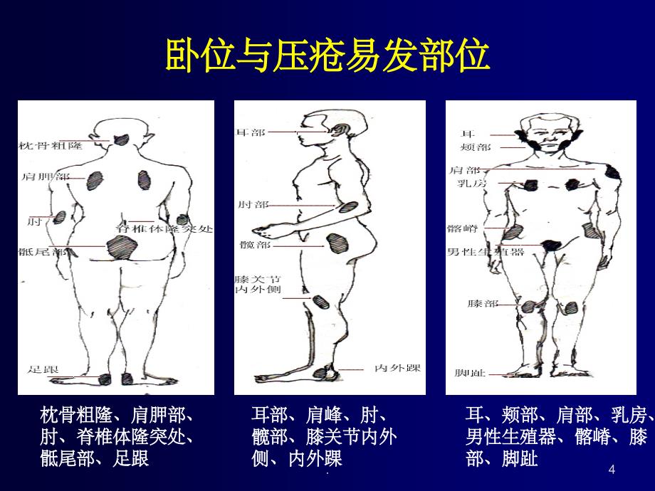 压疮预防与翻身法ppt课件_第4页