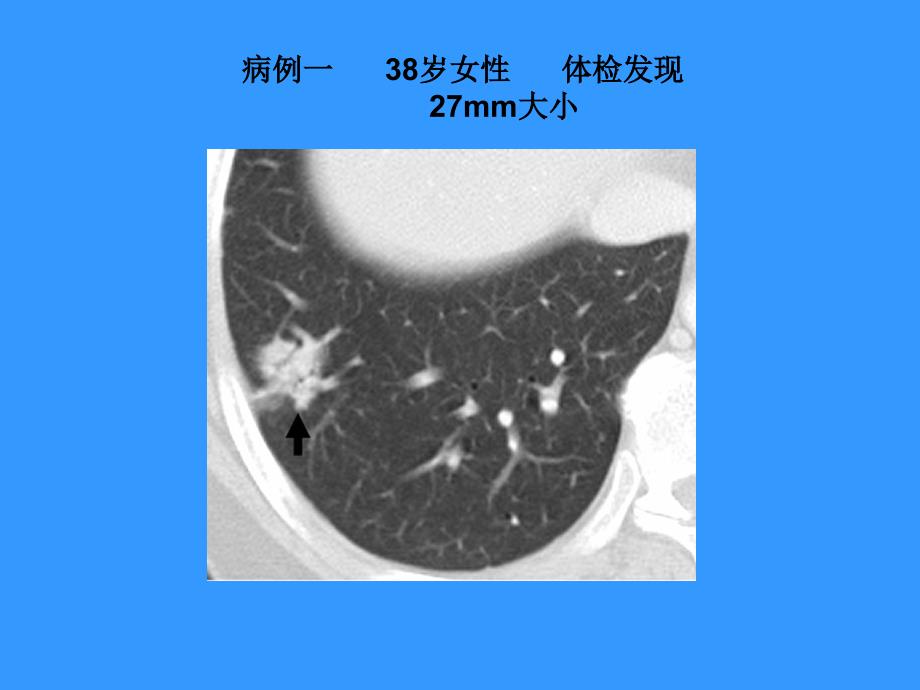 肺磨玻璃阴影影像诊断及临床处理原则PPT_第2页