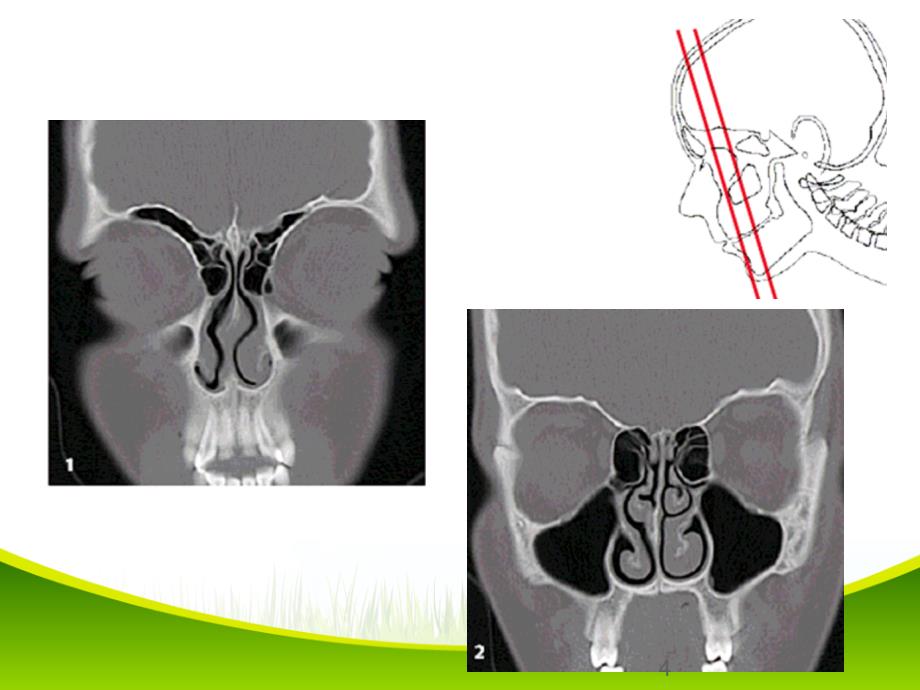 鼻和鼻窦病变CT诊断（课堂PPT）_第4页