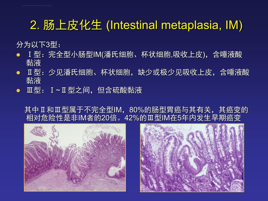 胃内癌前病变的诊断进展-周丽雅课件_第4页