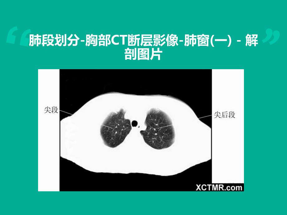 胸腹部CT阅片PPT_第3页