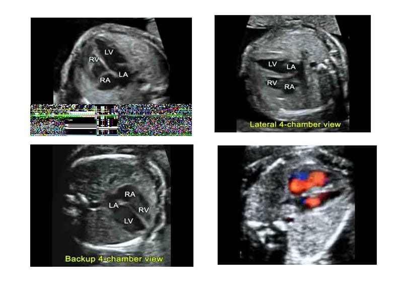 胎儿超声心动图讲座正常四腔观课件_第2页
