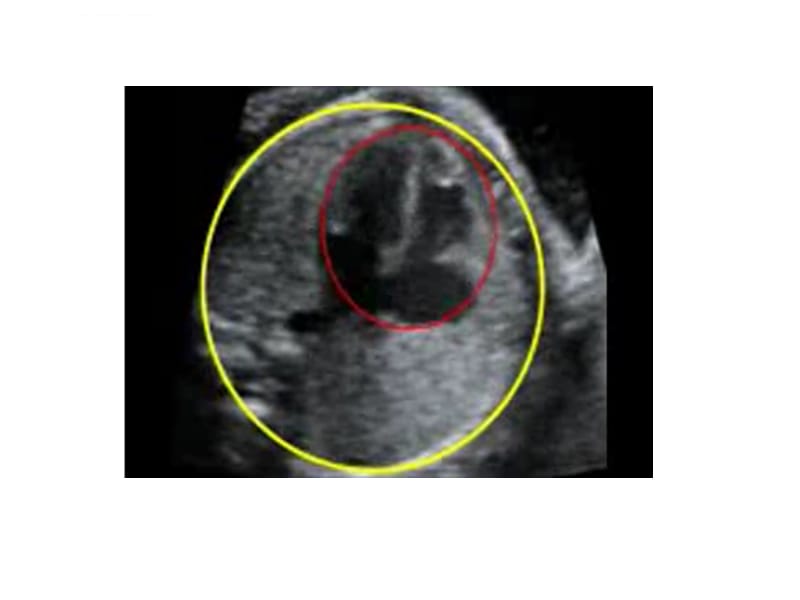 胎儿超声心动图讲座正常四腔观课件_第4页