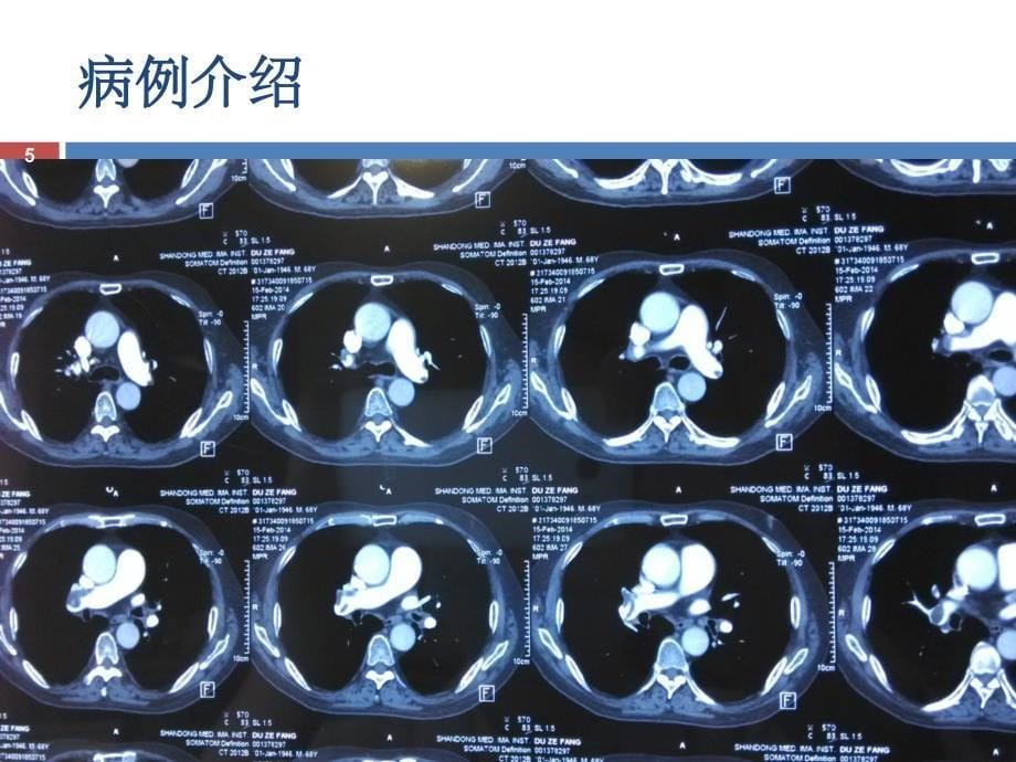 《肺栓塞病例分析》PPT课件_第5页