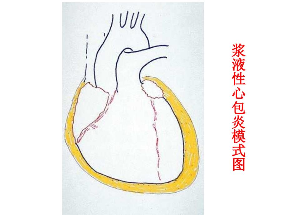 内科学心包积液及心脏压塞（课堂PPT）_第3页