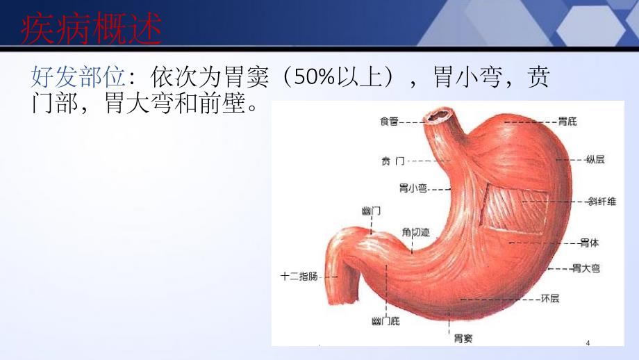 《胃癌术后的护理》PPT课件_第4页