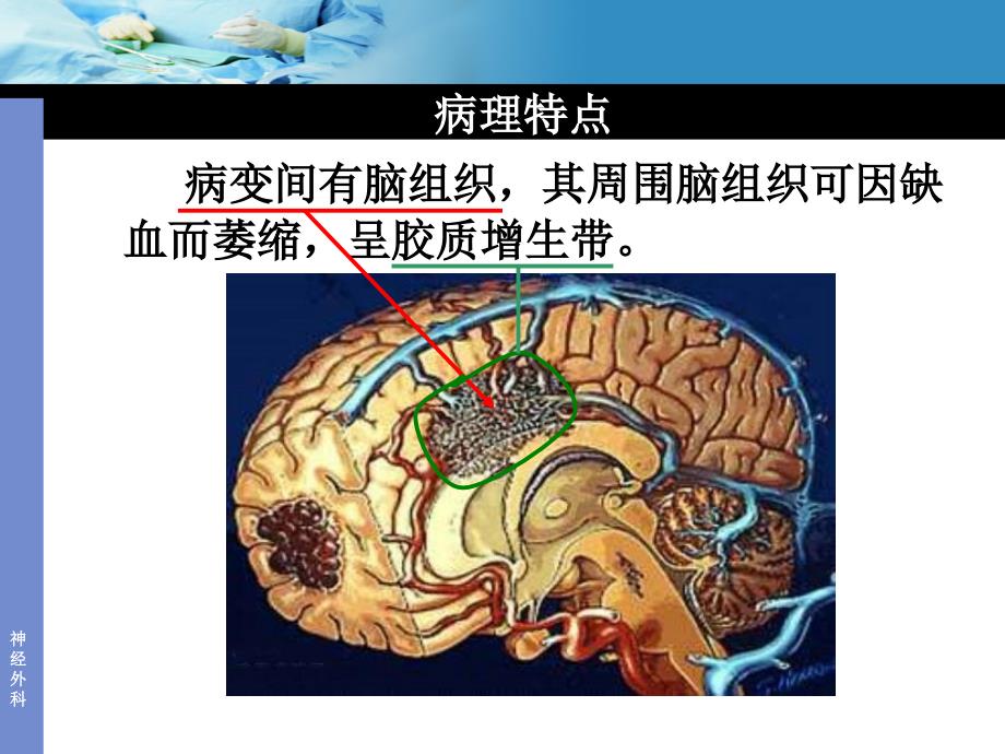 动静脉畸形AVM_第3页