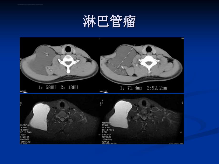 颈动脉间隙肿瘤的影像诊断-影像FTP课件_第4页