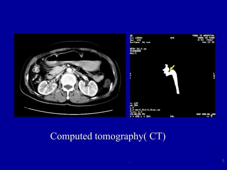 泌尿系-X线、CT、MR_第5页