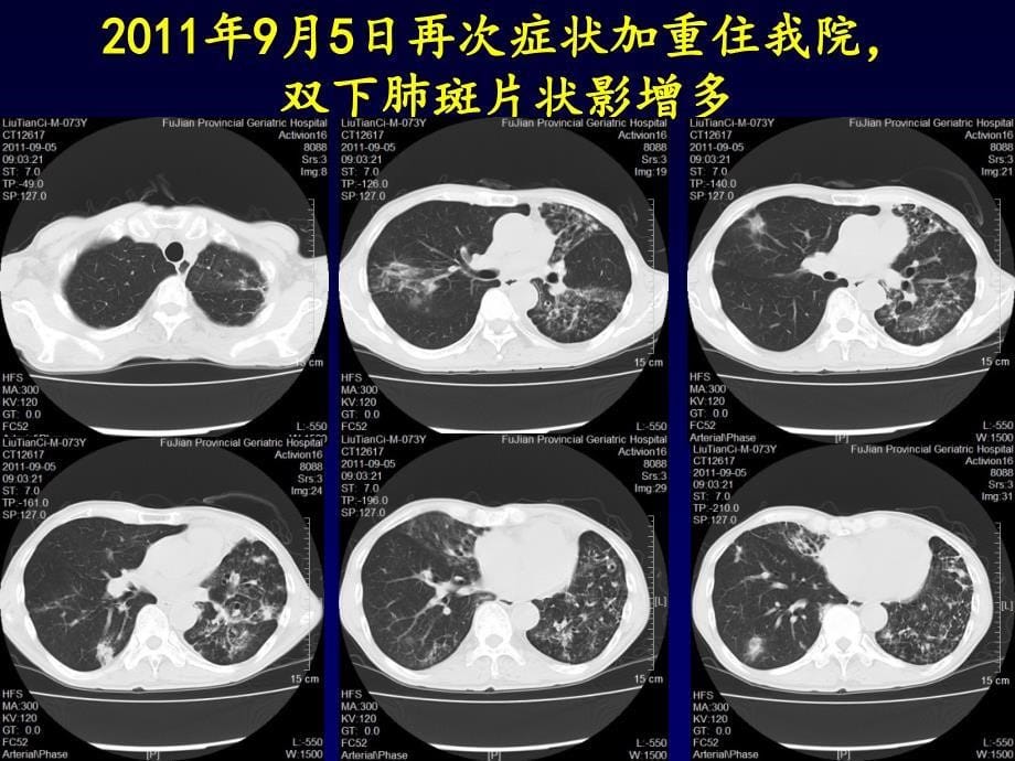 非结核分枝杆菌肺病课件_第5页