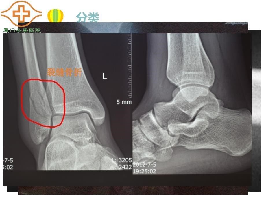 骨折 ppt课件-文档资料_第5页