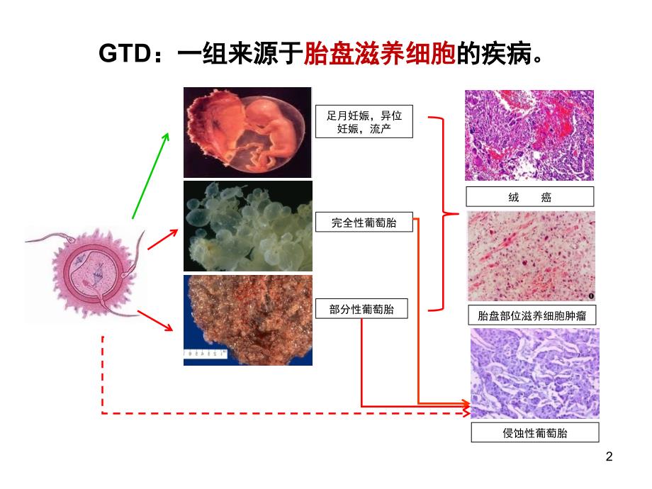 葡萄胎（课堂PPT）_第2页